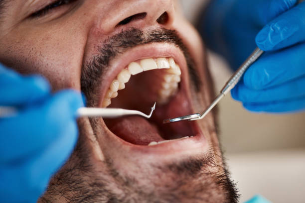 Best Emergency Dentist for Lost Fillings or Crowns in Manasquan, NJ